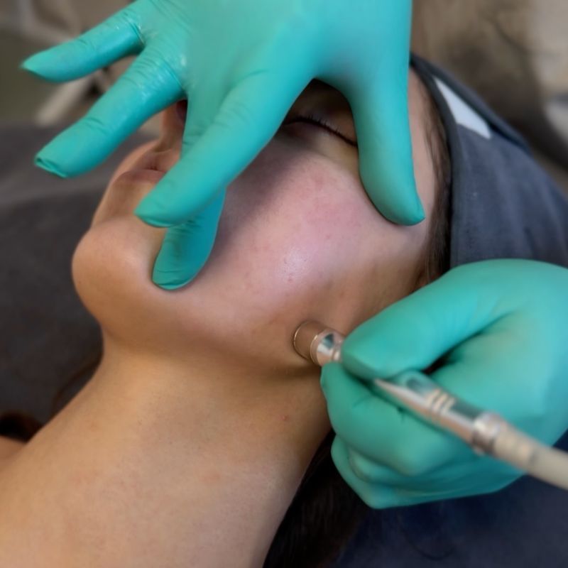 Diamant Mikrodermabrasion
