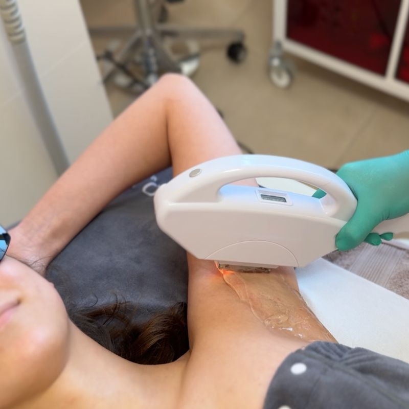 Laser Haarentfernung mit dem IPL-SHR Laser
