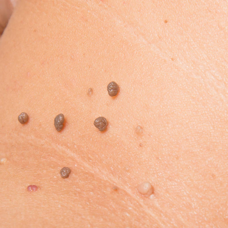 Fibrom & Blutschwämmchen