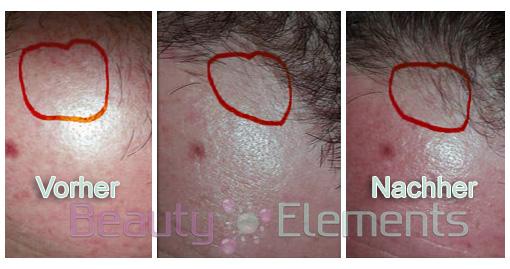 Beauty Elements Meso Hair
