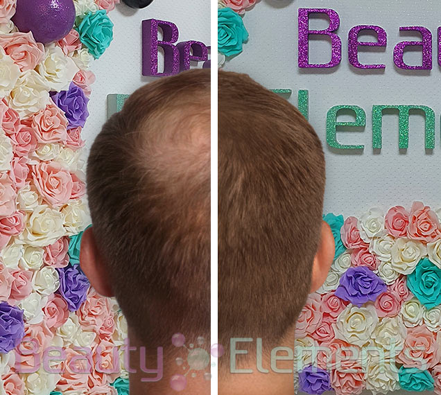 Mesohair Fusion